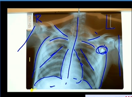 (Thoracic x-ray of Jordan Davis body..)